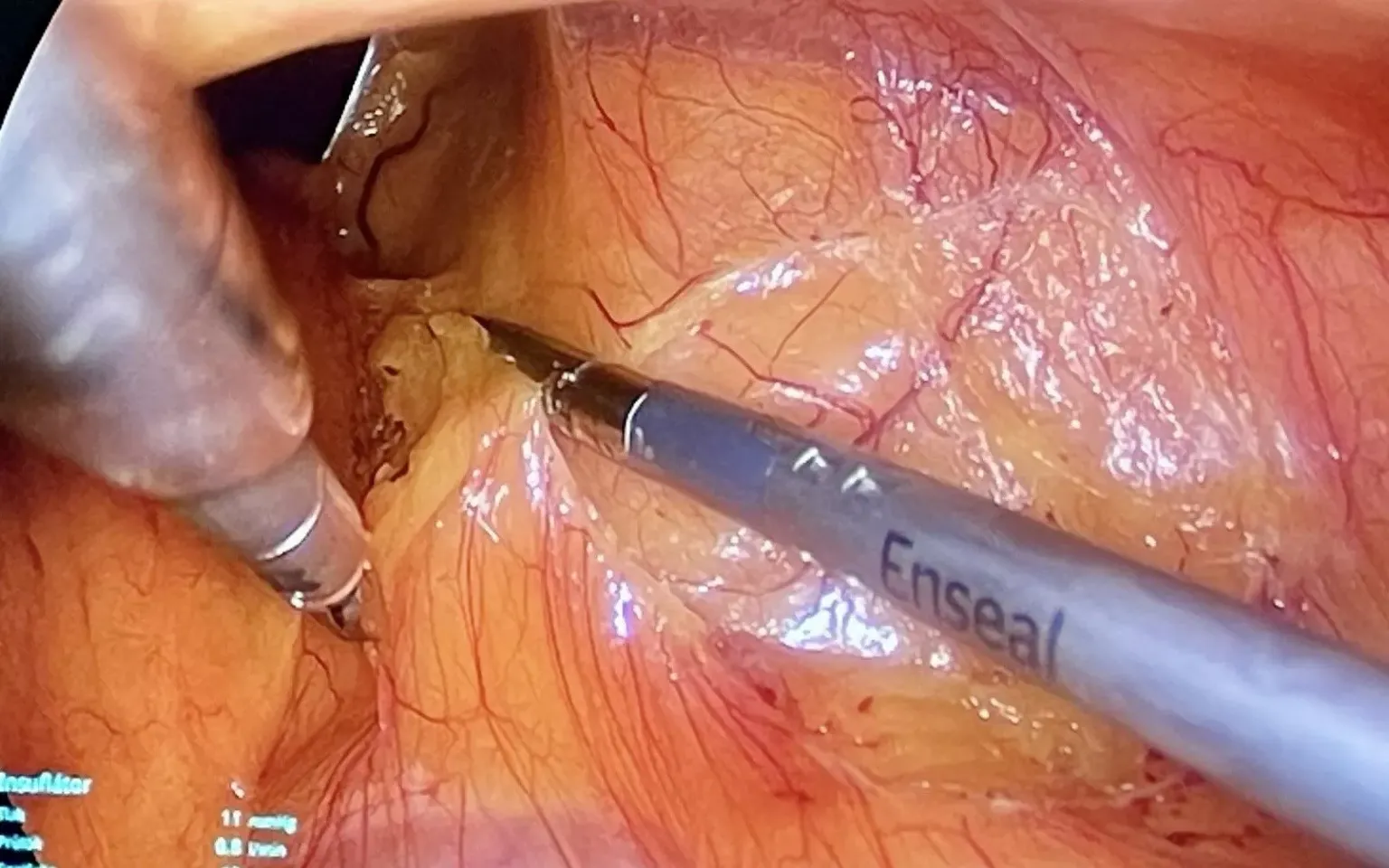 Nový urologický tým provedl první laparoskopickou nefrektomii v benešovské nemocnici